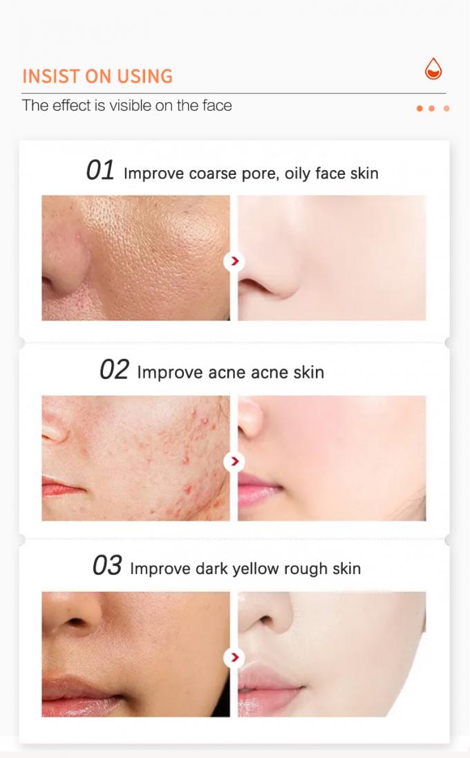 toner pour la peau encline d'acné