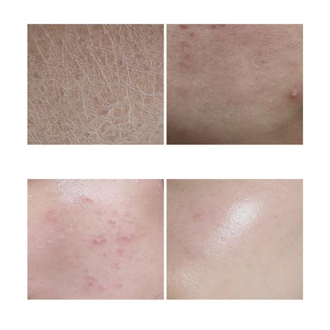 peau rayonnante Rosacea avancé 1 de rougeur pure du sérum 100% de visage de l'essence 30ml