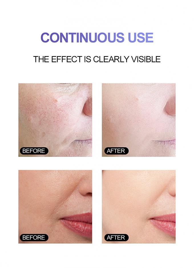 peau rayonnante Rosacea avancé 1 de rougeur pure du sérum 100% de visage de l'essence 30ml