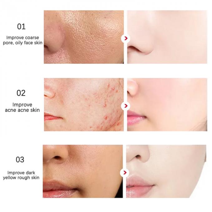 peau rayonnante Rosacea avancé 1 de rougeur pure du sérum 100% de visage de l'essence 30ml