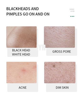 Ramollissez Lackhead a dérivé le sérum de solvant de point noir de sérum de visage d'essence