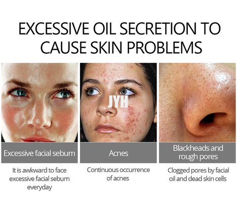 Traitement doux d'acné de soins de la peau 30g crème pour la peau sensible encline d'acné